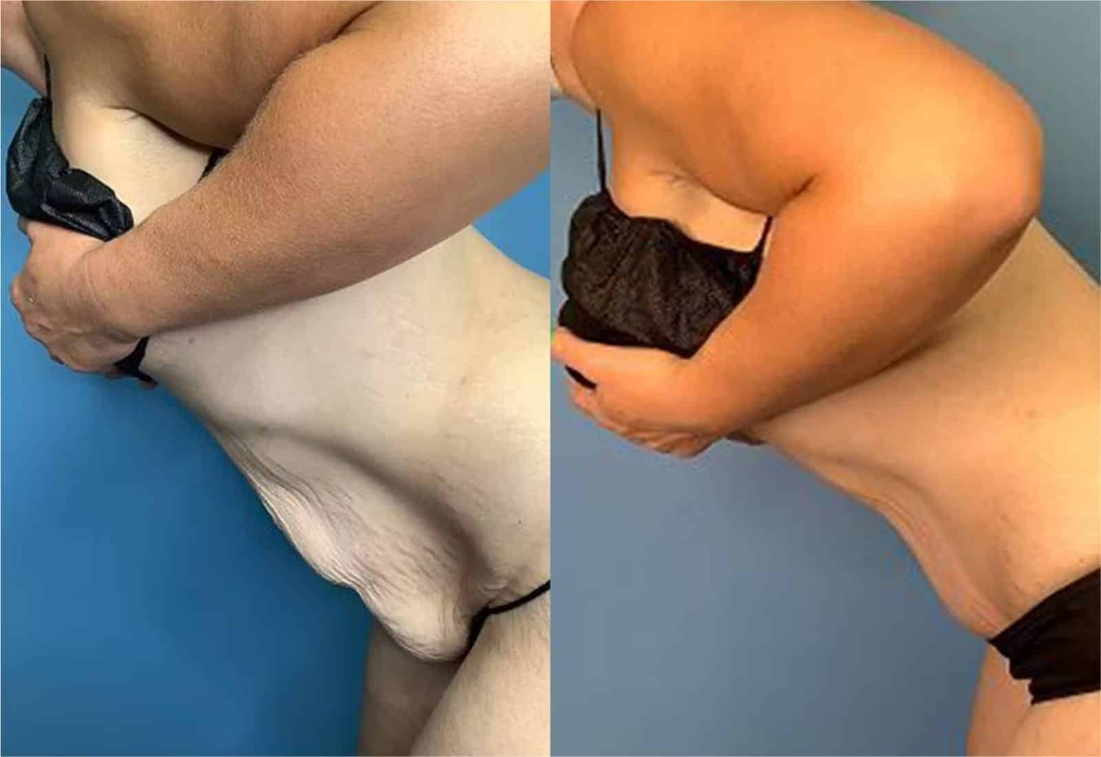 Before and After Image: Tummy Tuck (Abdominoplasty) - other