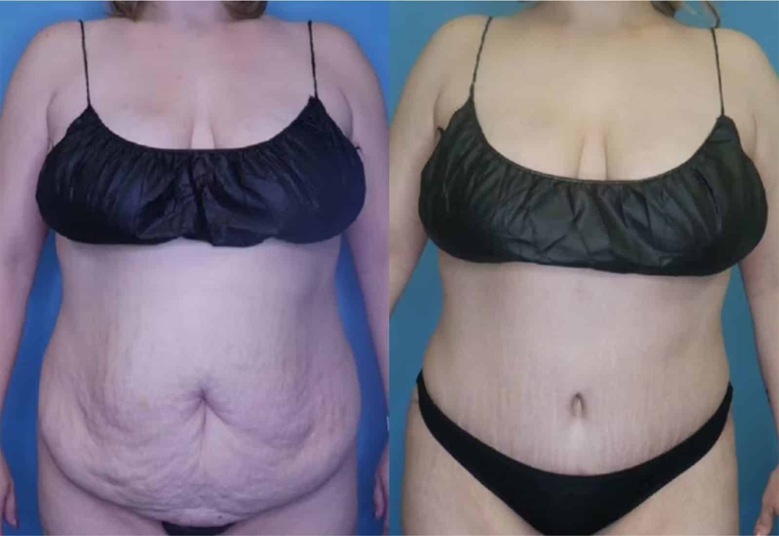 Before and After Image: Tummy Tuck (Abdominoplasty) - front