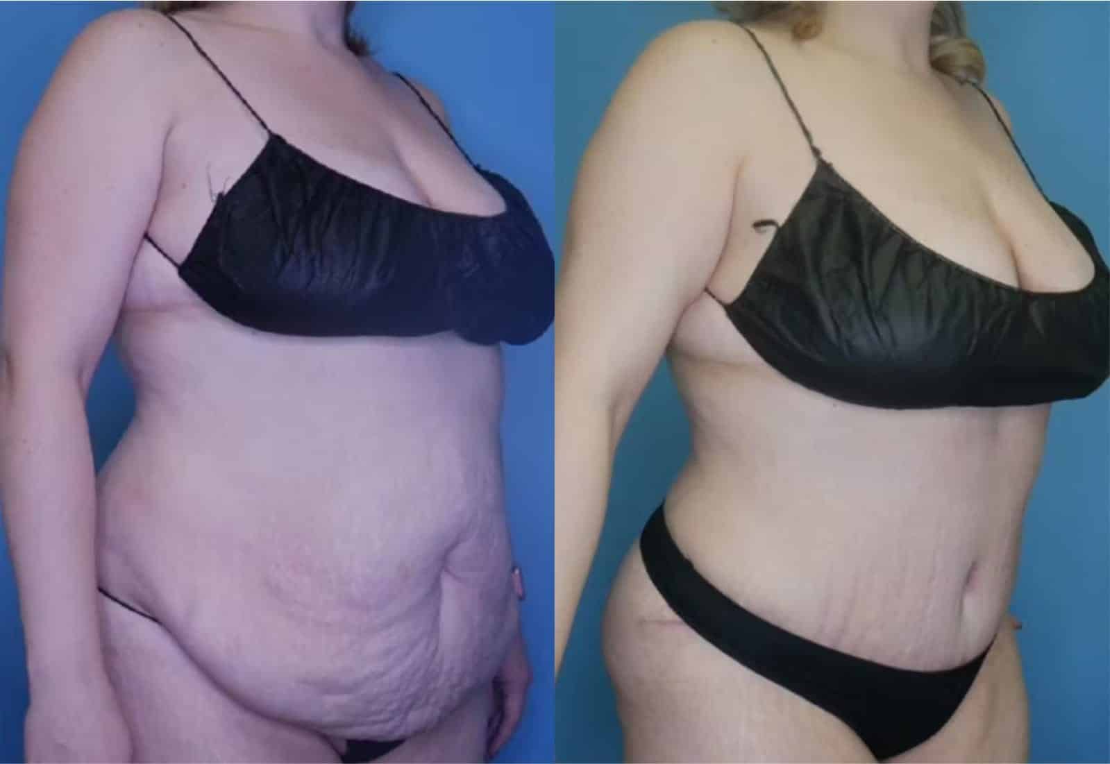 Before and After Image: Tummy Tuck (Abdominoplasty) - right-front-oblique