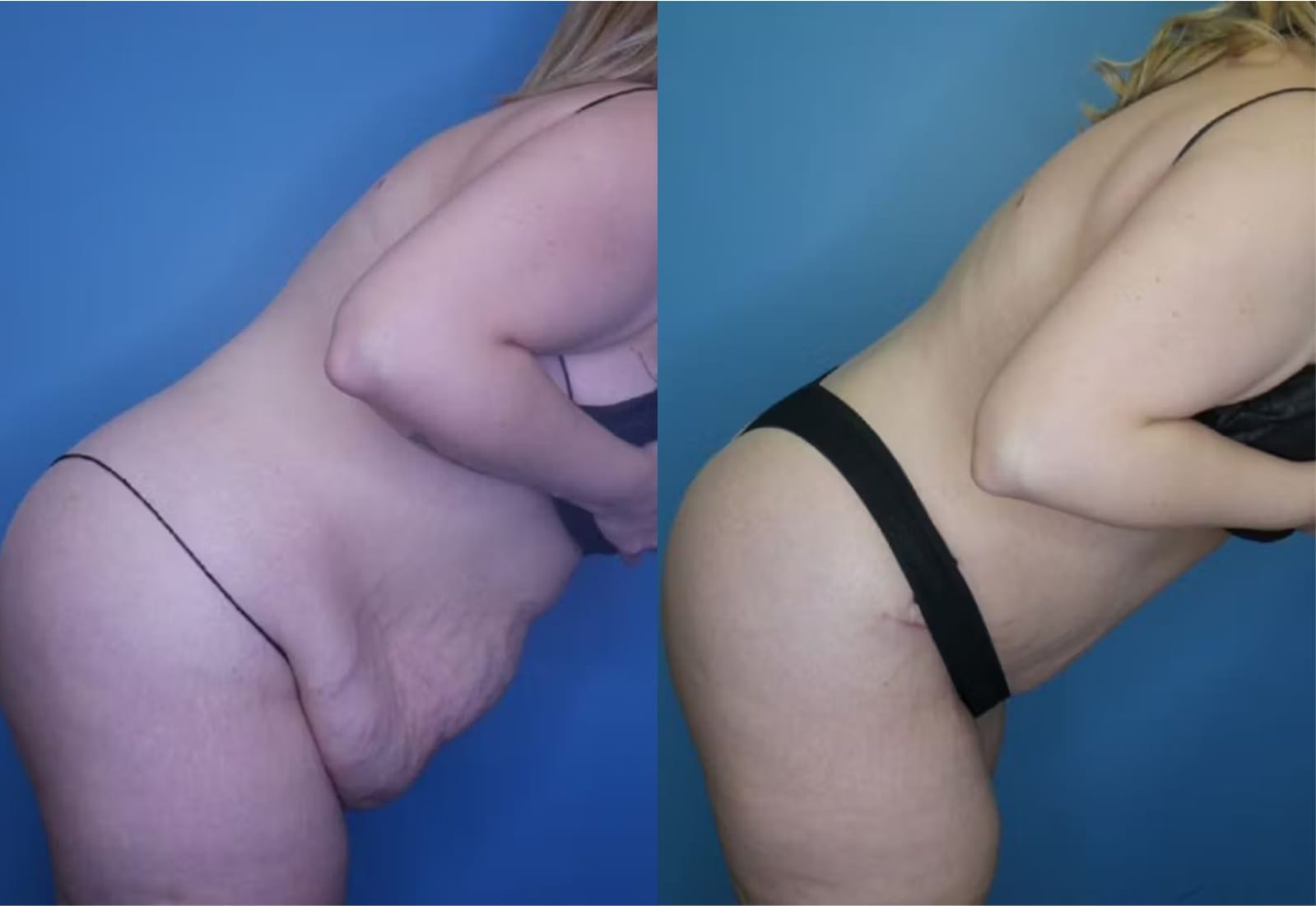 Before and After Image: Tummy Tuck (Abdominoplasty) - other