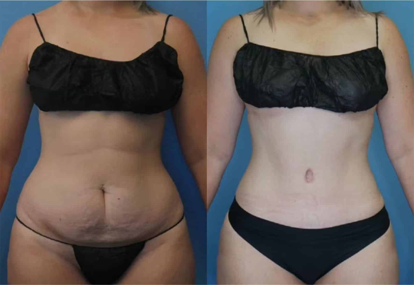 Before and After Image: Tummy Tuck (Abdominoplasty) - front
