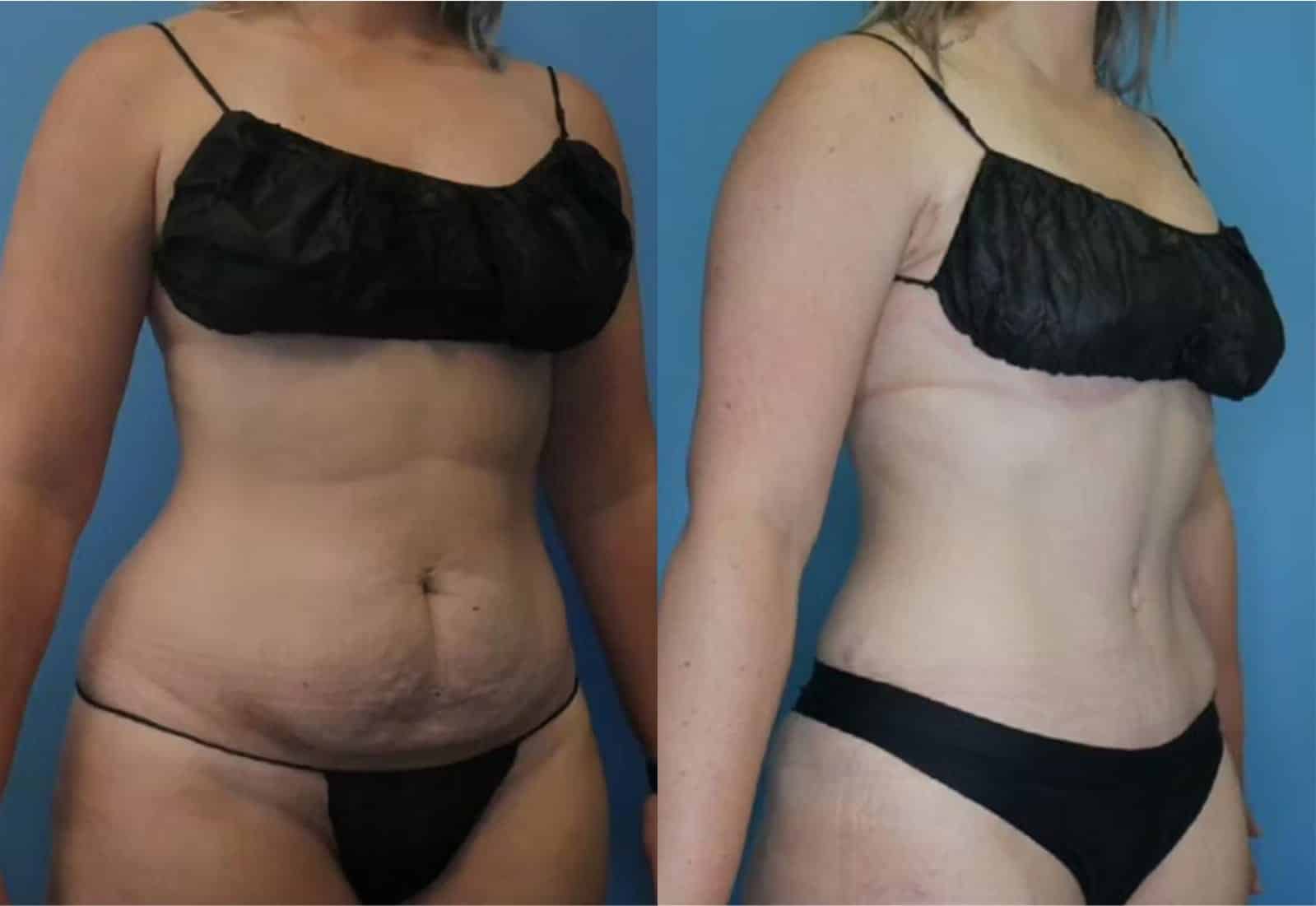 Before and After Image: Tummy Tuck (Abdominoplasty) - right-front-oblique