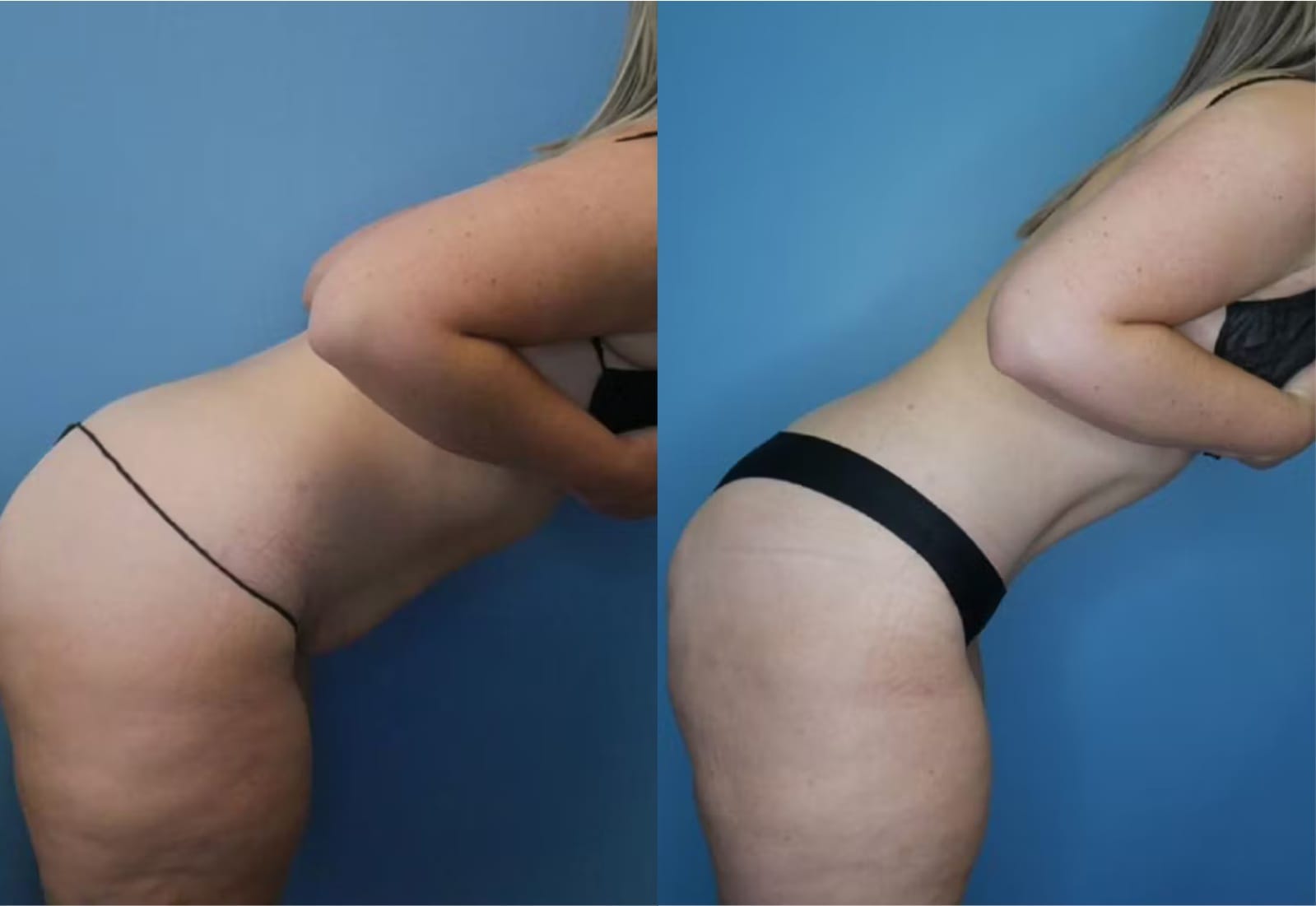Before and After Image: Tummy Tuck (Abdominoplasty) - other