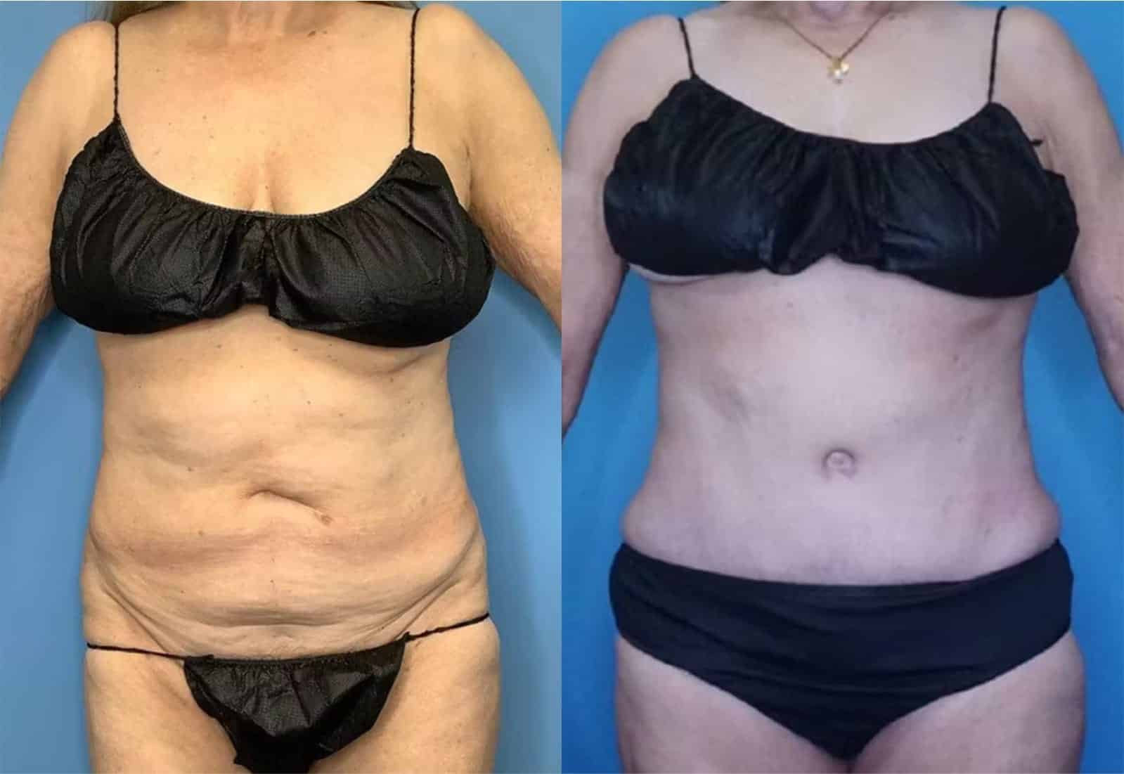 Before and After Image: Tummy Tuck (Abdominoplasty) - front