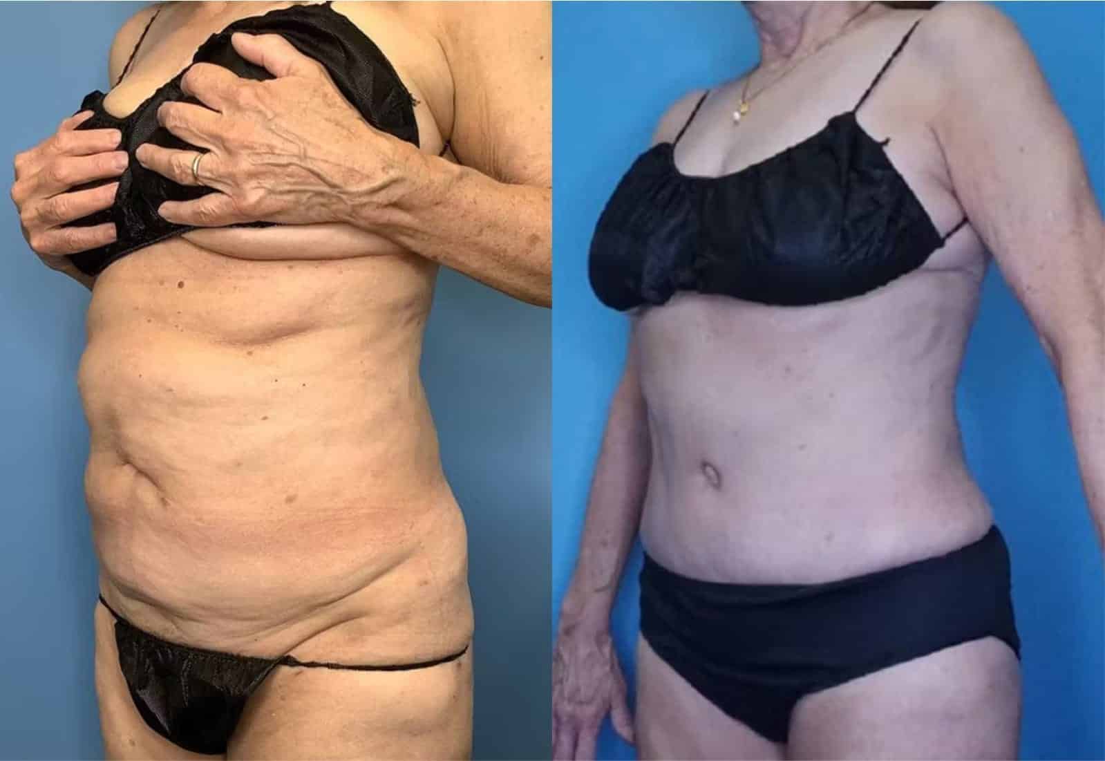 Before and After Image: Tummy Tuck (Abdominoplasty) - left-front-oblique