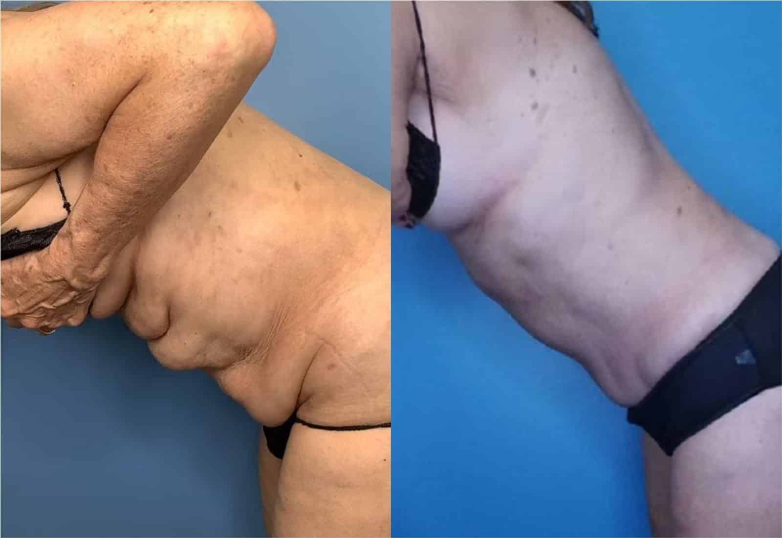 Before and After Image: Tummy Tuck (Abdominoplasty) - other