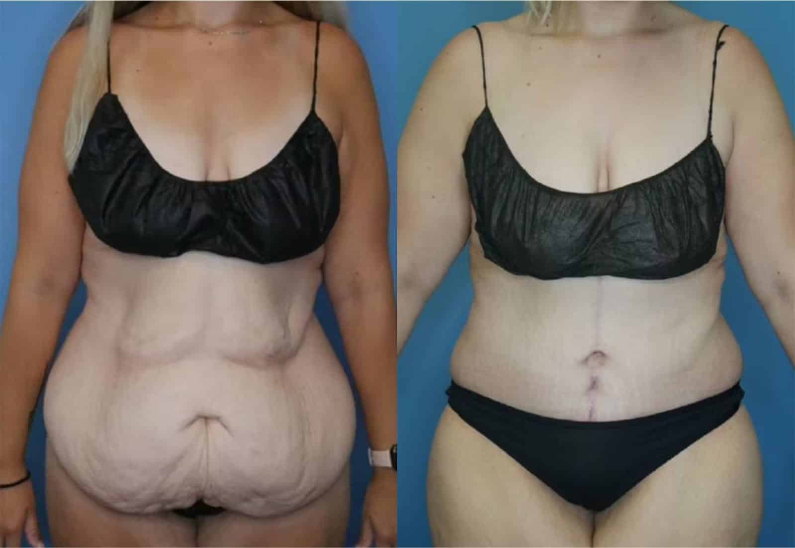 Before and After Image: Tummy Tuck (Abdominoplasty) - front