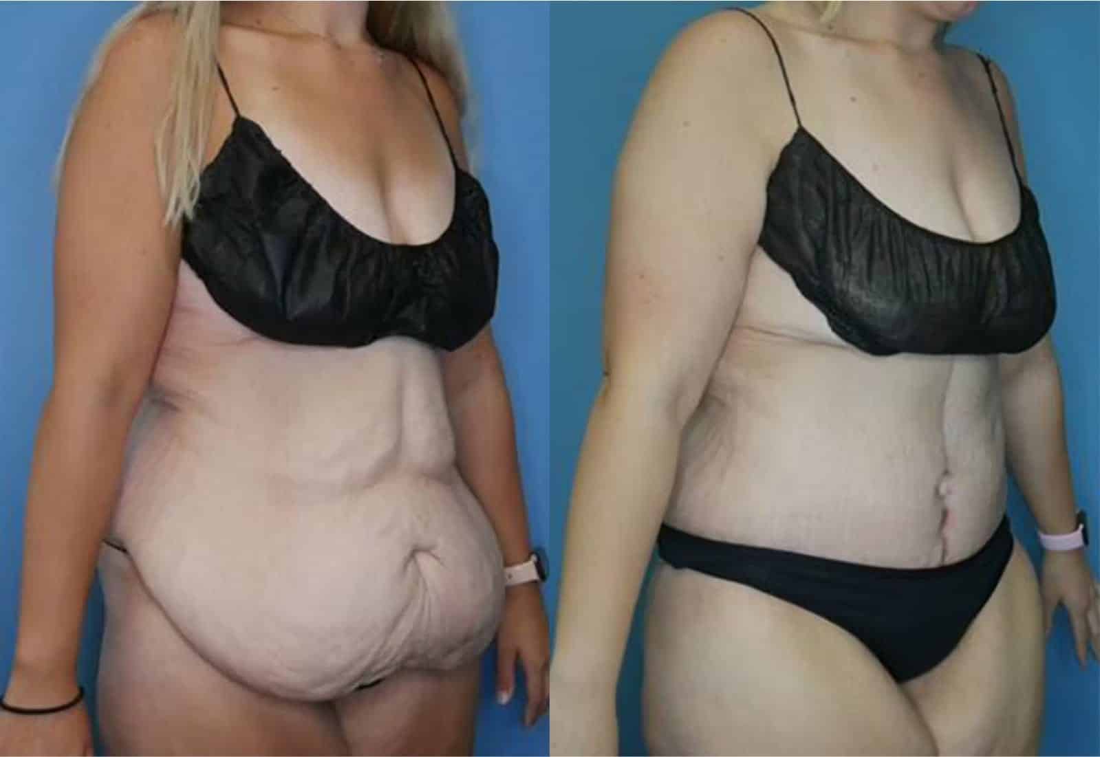 Before and After Image: Tummy Tuck (Abdominoplasty) - right-front-oblique