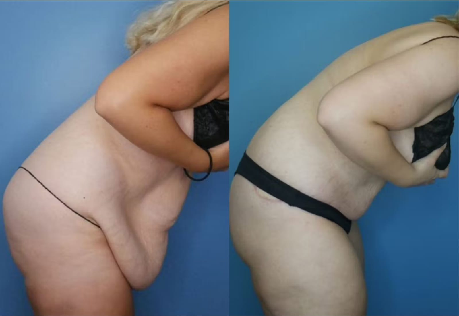 Before and After Image: Tummy Tuck (Abdominoplasty) - other
