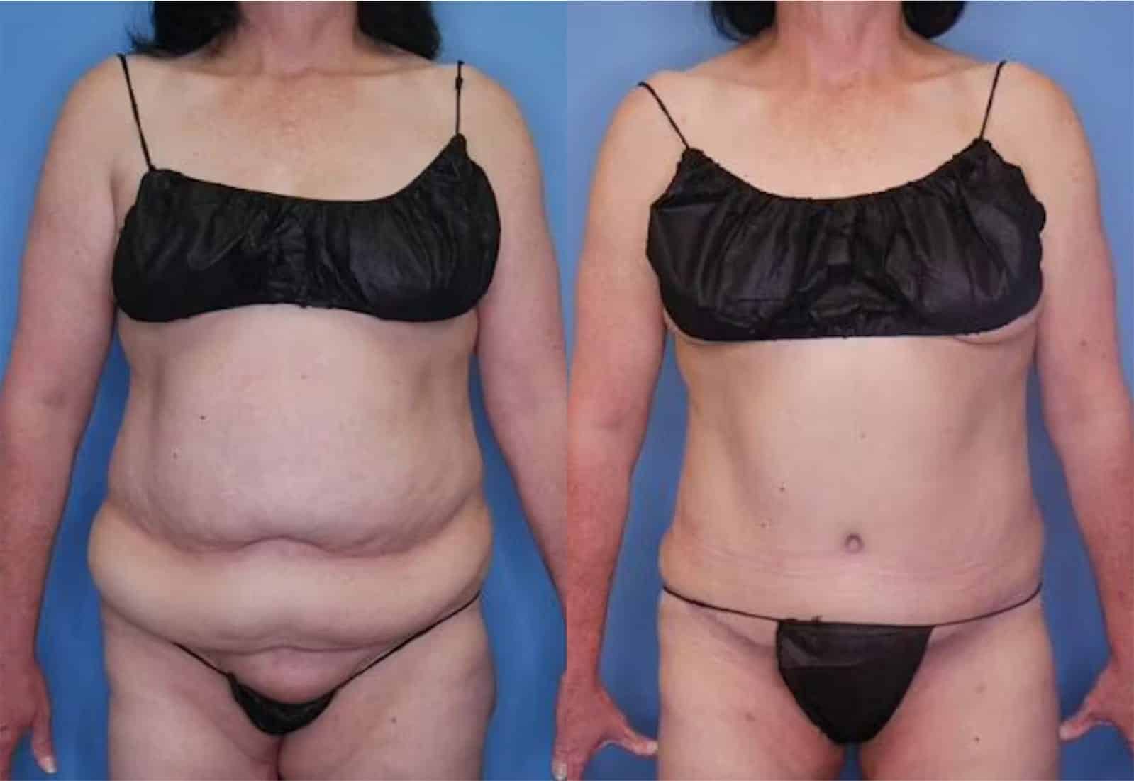 Before and After Image: Tummy Tuck (Abdominoplasty) - front