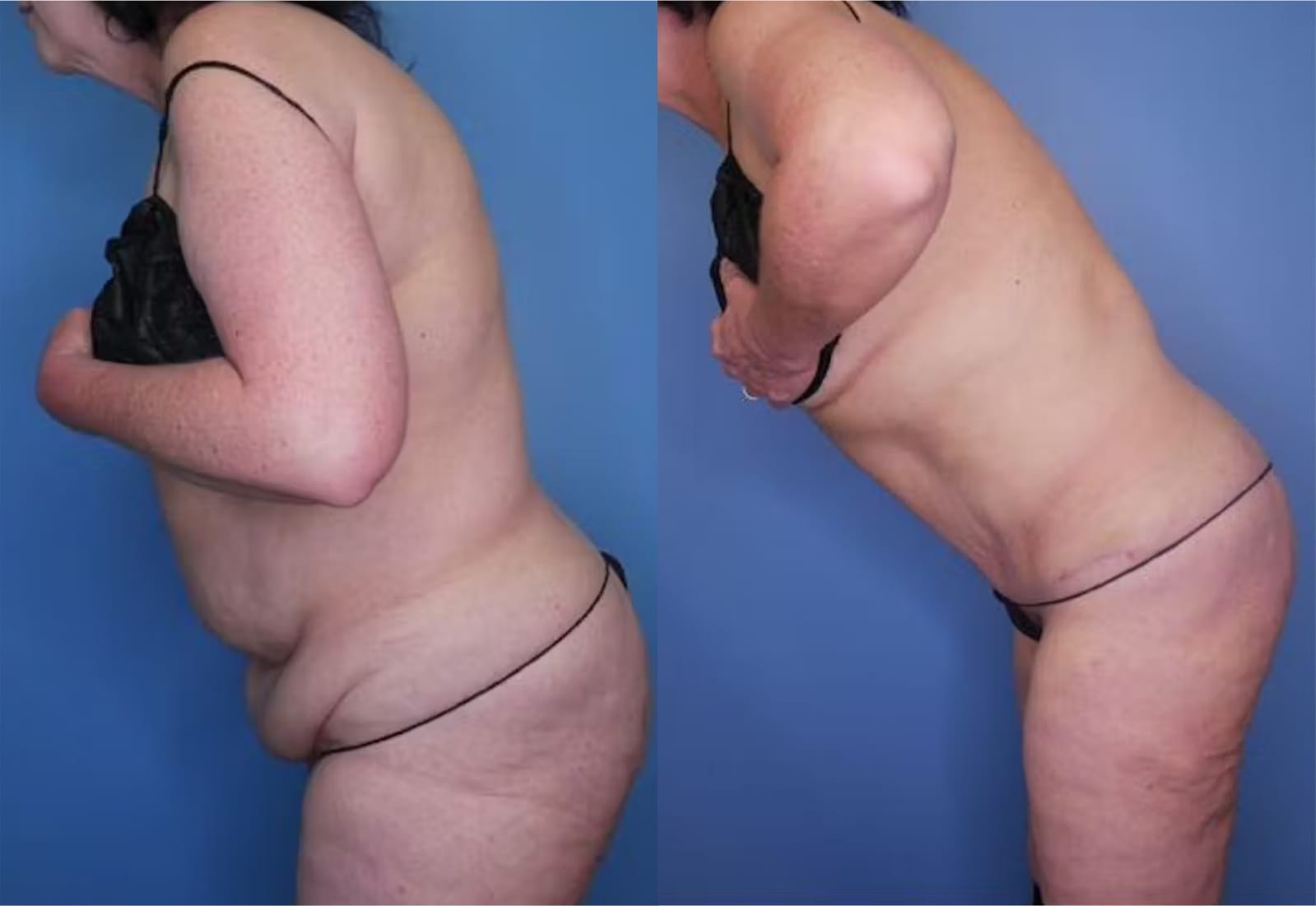 Before and After Image: Tummy Tuck (Abdominoplasty) - other