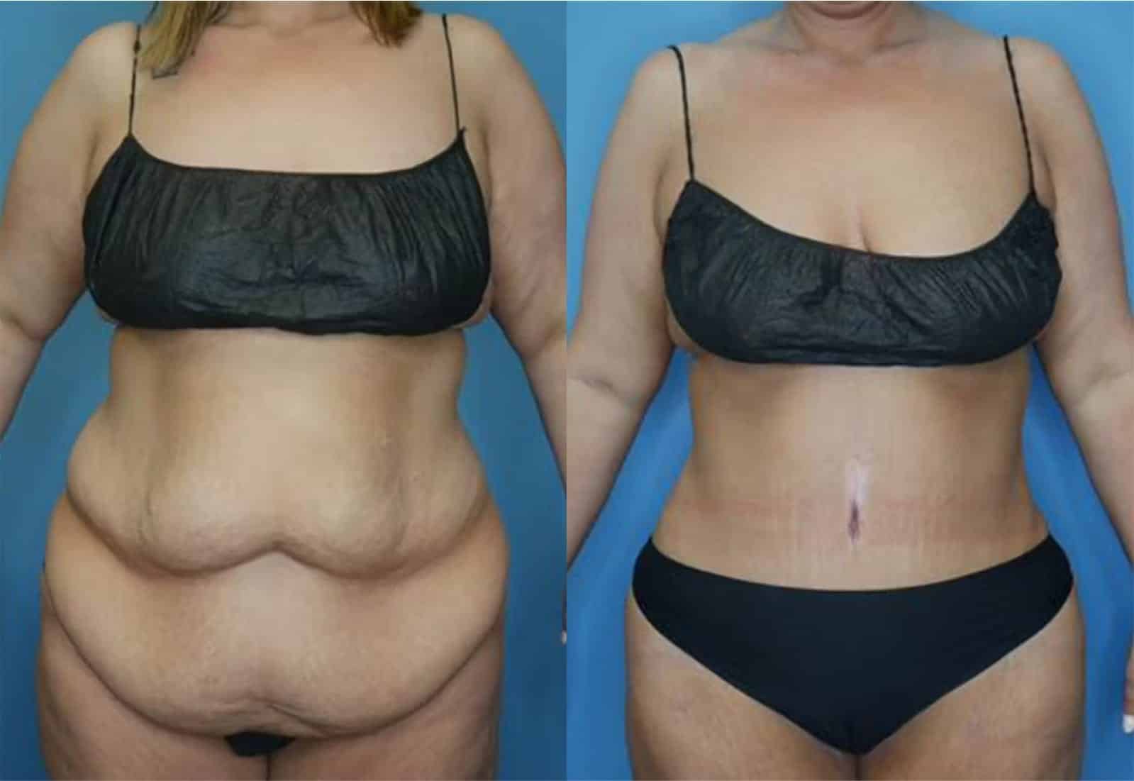 Before and After Image: Tummy Tuck (Abdominoplasty) - front