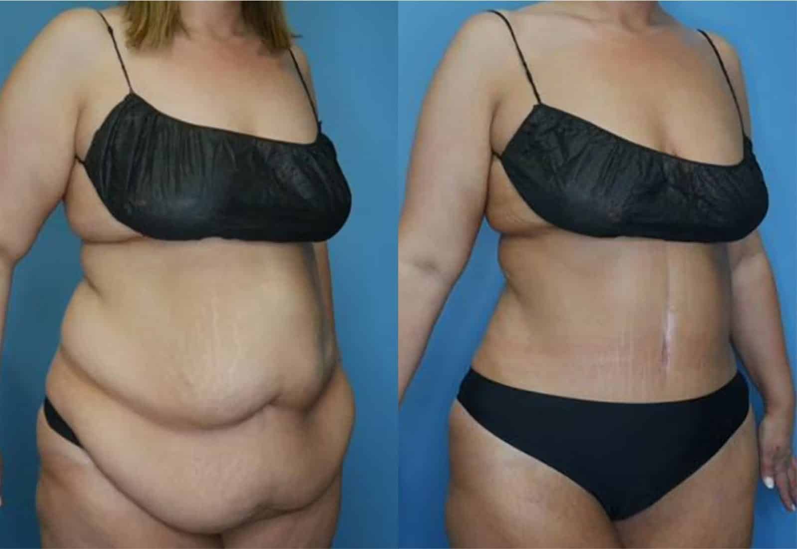 Before and After Image: Tummy Tuck (Abdominoplasty) - right-front-oblique