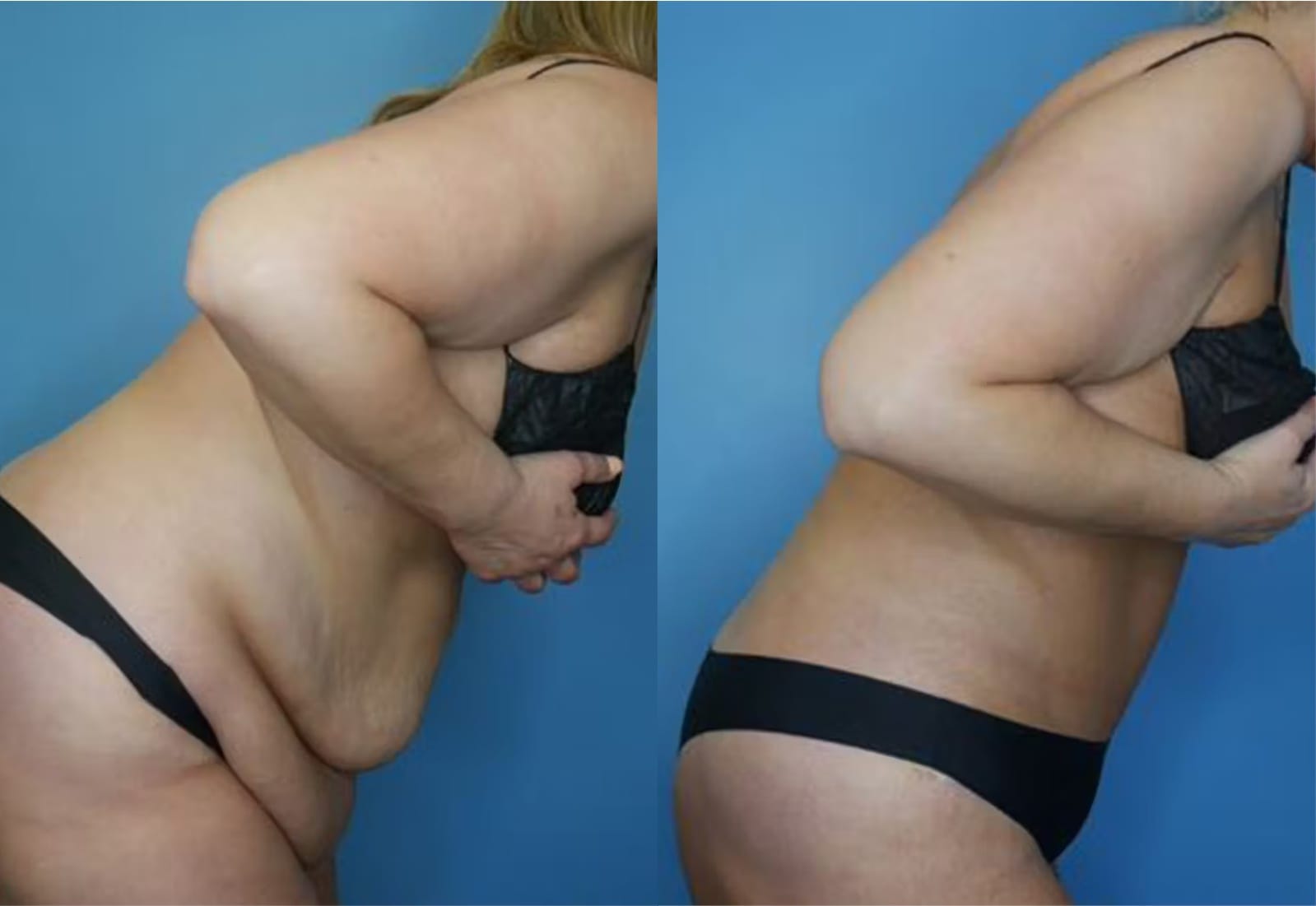 Before and After Image: Tummy Tuck (Abdominoplasty) - other