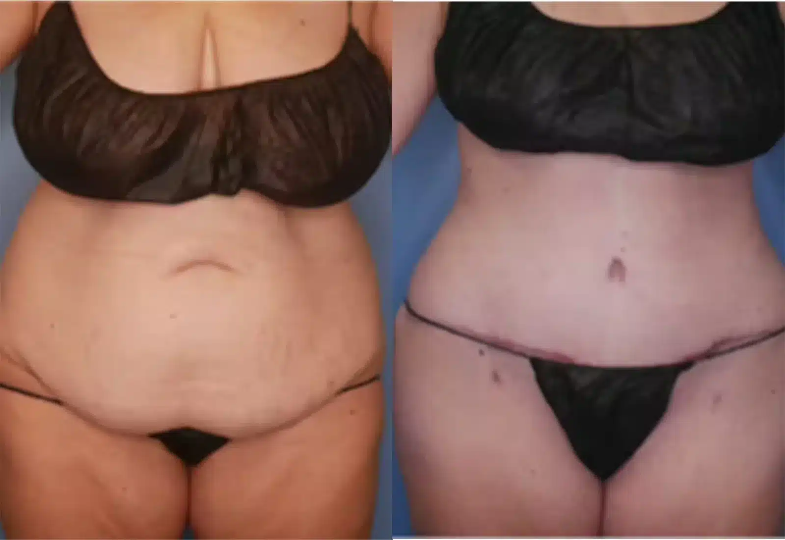 Before and After Image: Tummy Tuck (Abdominoplasty) - front