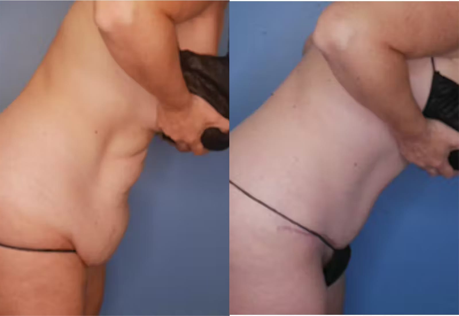 Before and After Image: Tummy Tuck (Abdominoplasty) - right-side