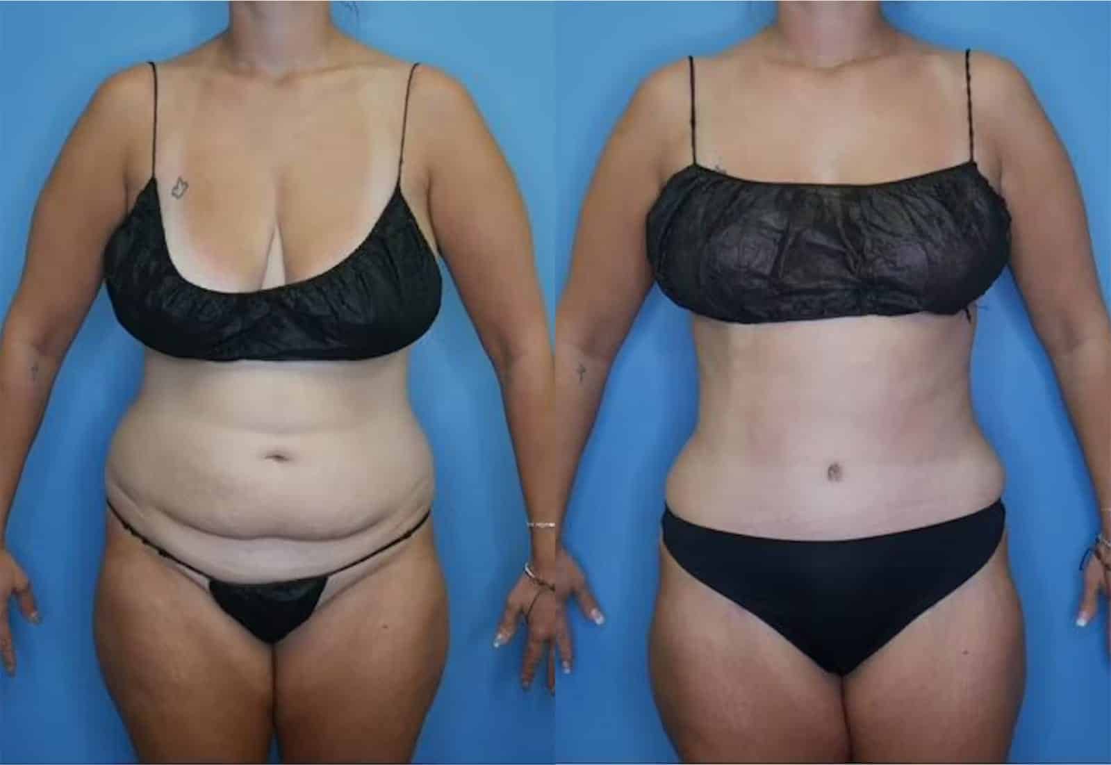 Before and After Image: Tummy Tuck (Abdominoplasty) - front