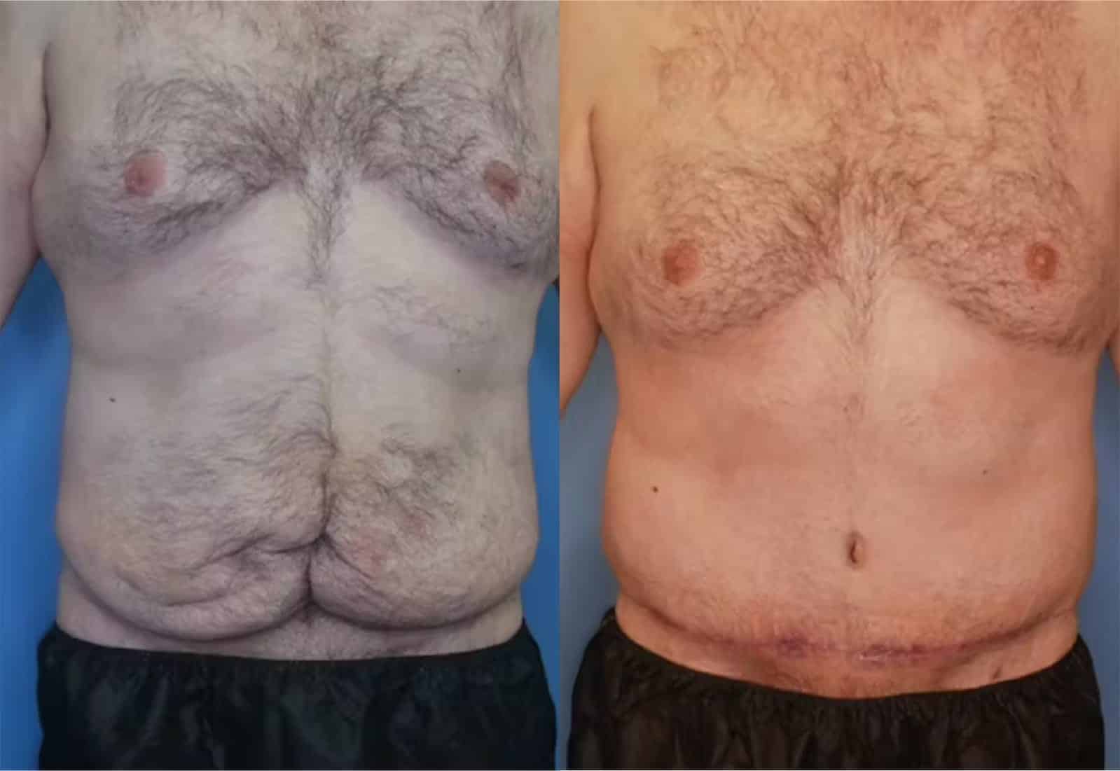 Before and After Image: Tummy Tuck (Abdominoplasty) - front