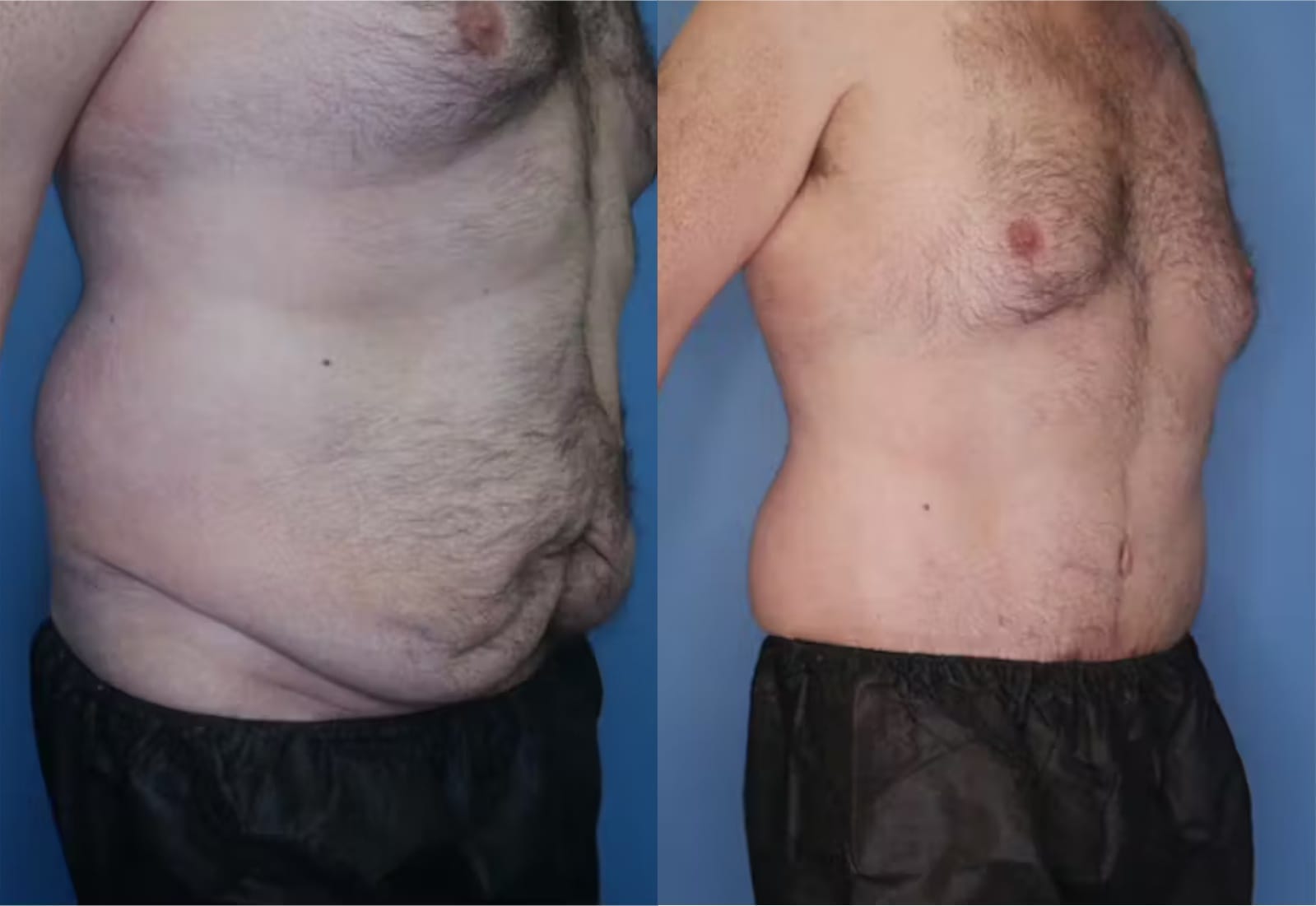 Before and After Image: Tummy Tuck (Abdominoplasty) - right-front-oblique