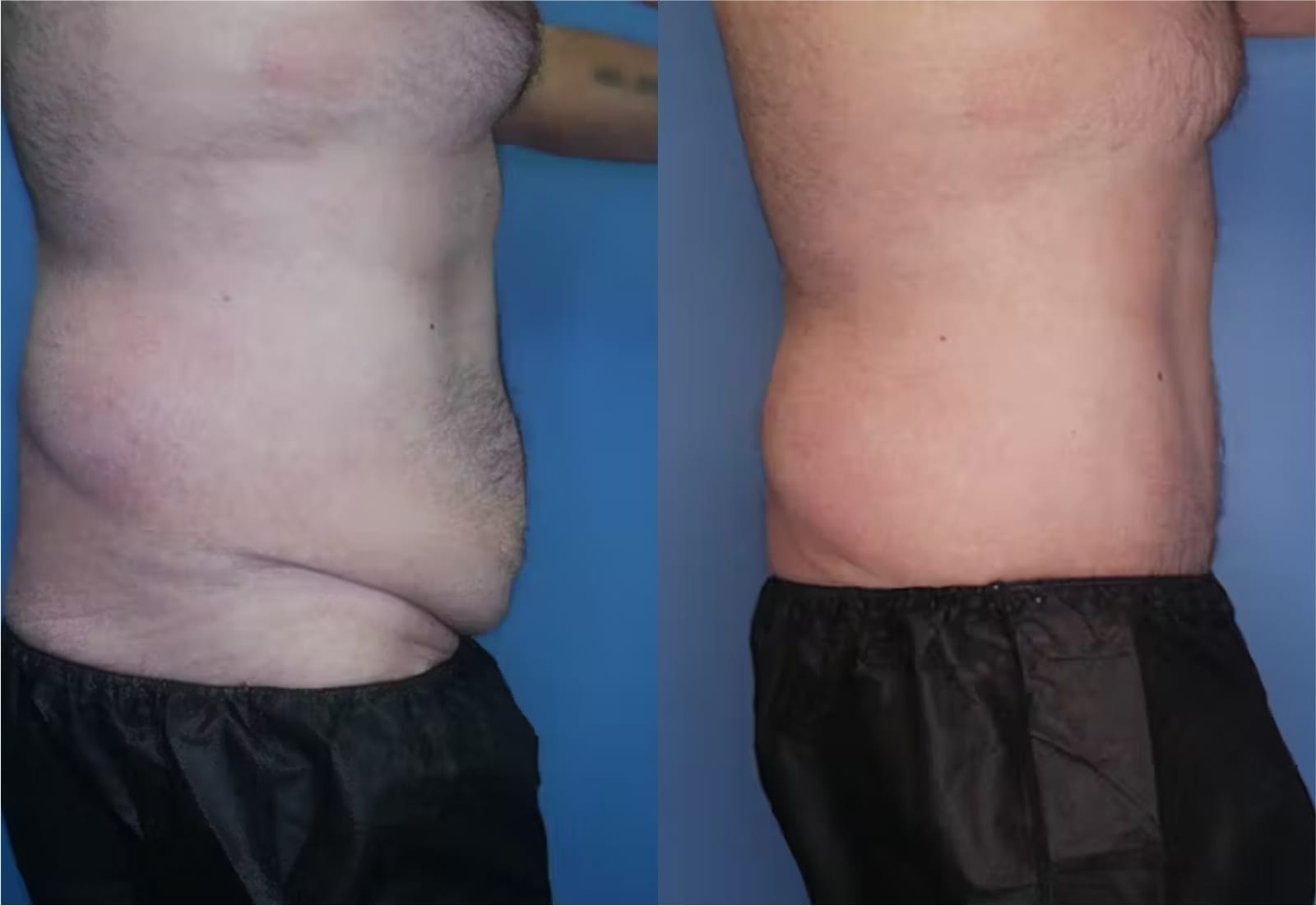 Before and After Image: Tummy Tuck (Abdominoplasty) - right-side