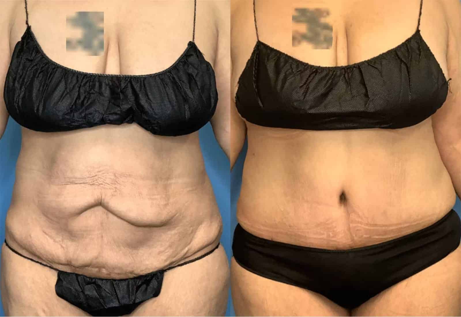 Before and After Image: Tummy Tuck (Abdominoplasty) - front