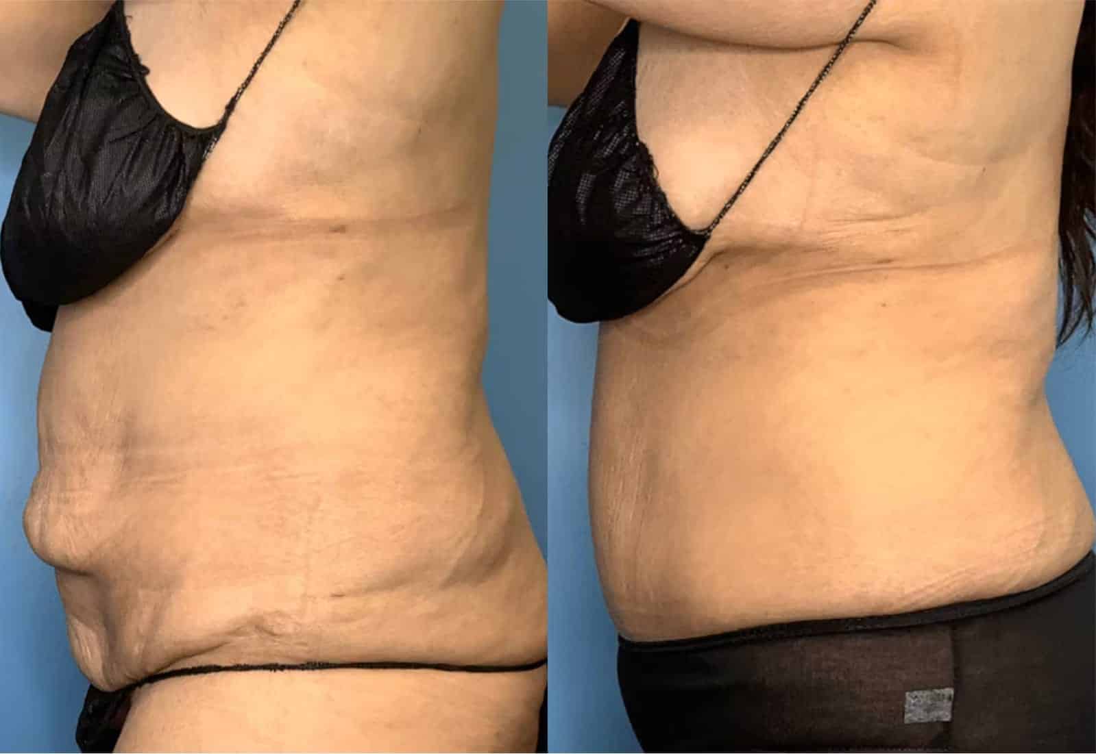 Before and After Image: Tummy Tuck (Abdominoplasty) - left-side
