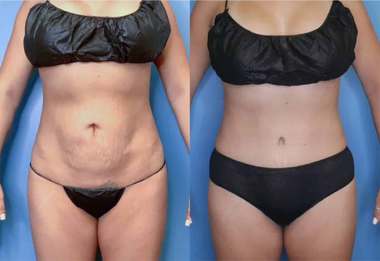 Before and After Image: Tummy Tuck (Abdominoplasty) - front