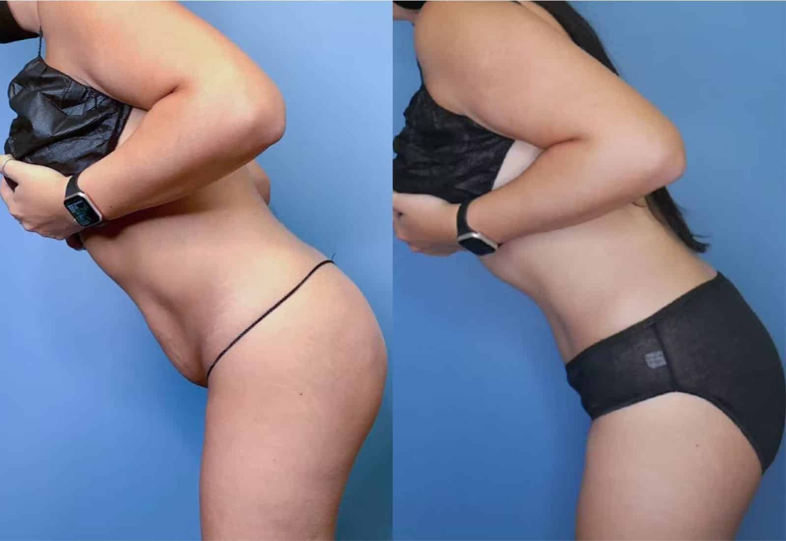 Before and After Image: Tummy Tuck (Abdominoplasty) - left-side