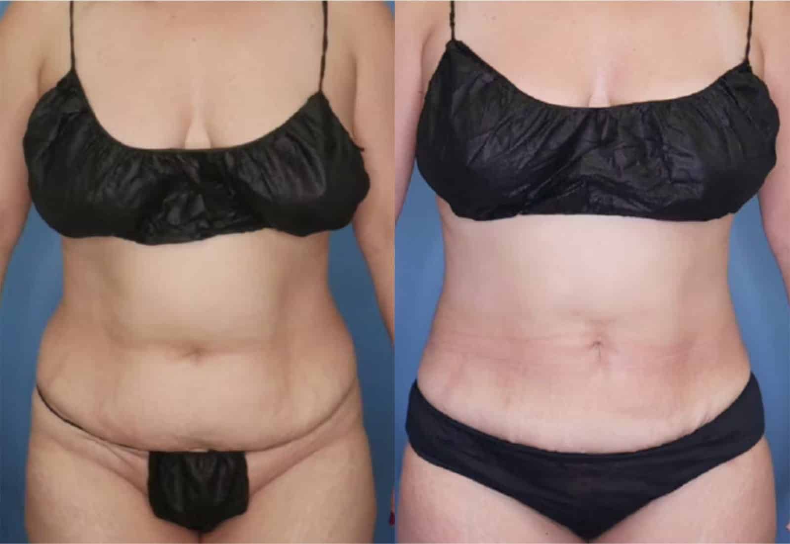 Before and After Image: Tummy Tuck (Abdominoplasty) - front