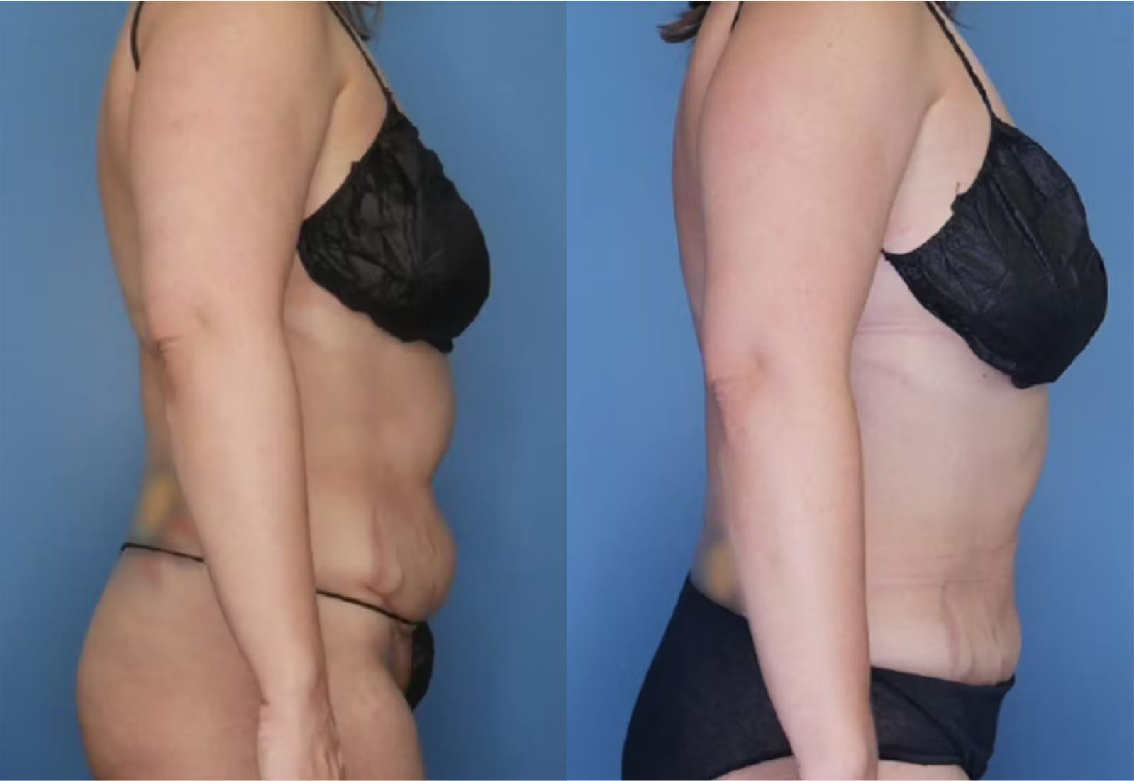 Before and After Image: Tummy Tuck (Abdominoplasty) - right-side