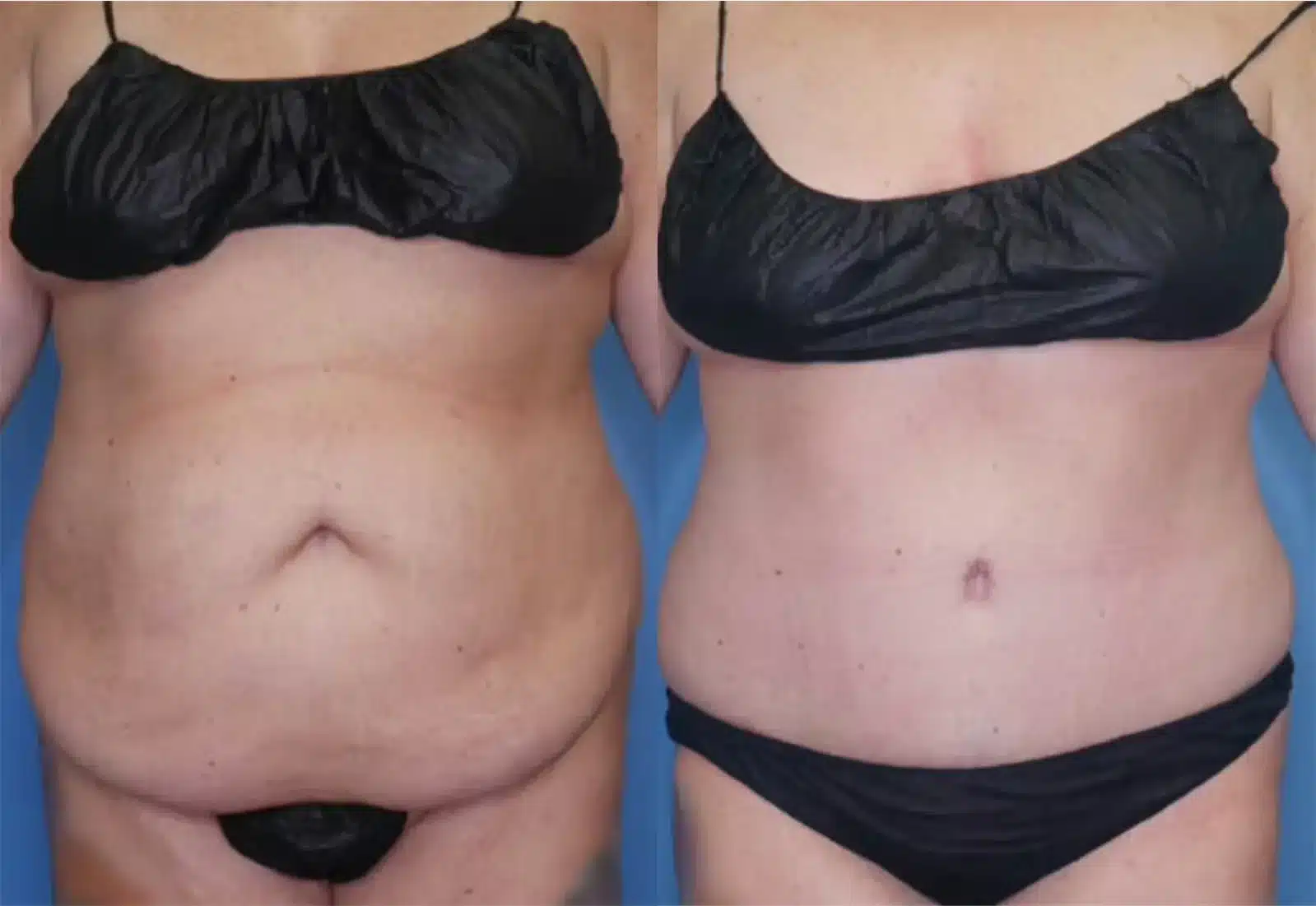 Before and After Image: Tummy Tuck (Abdominoplasty) - front
