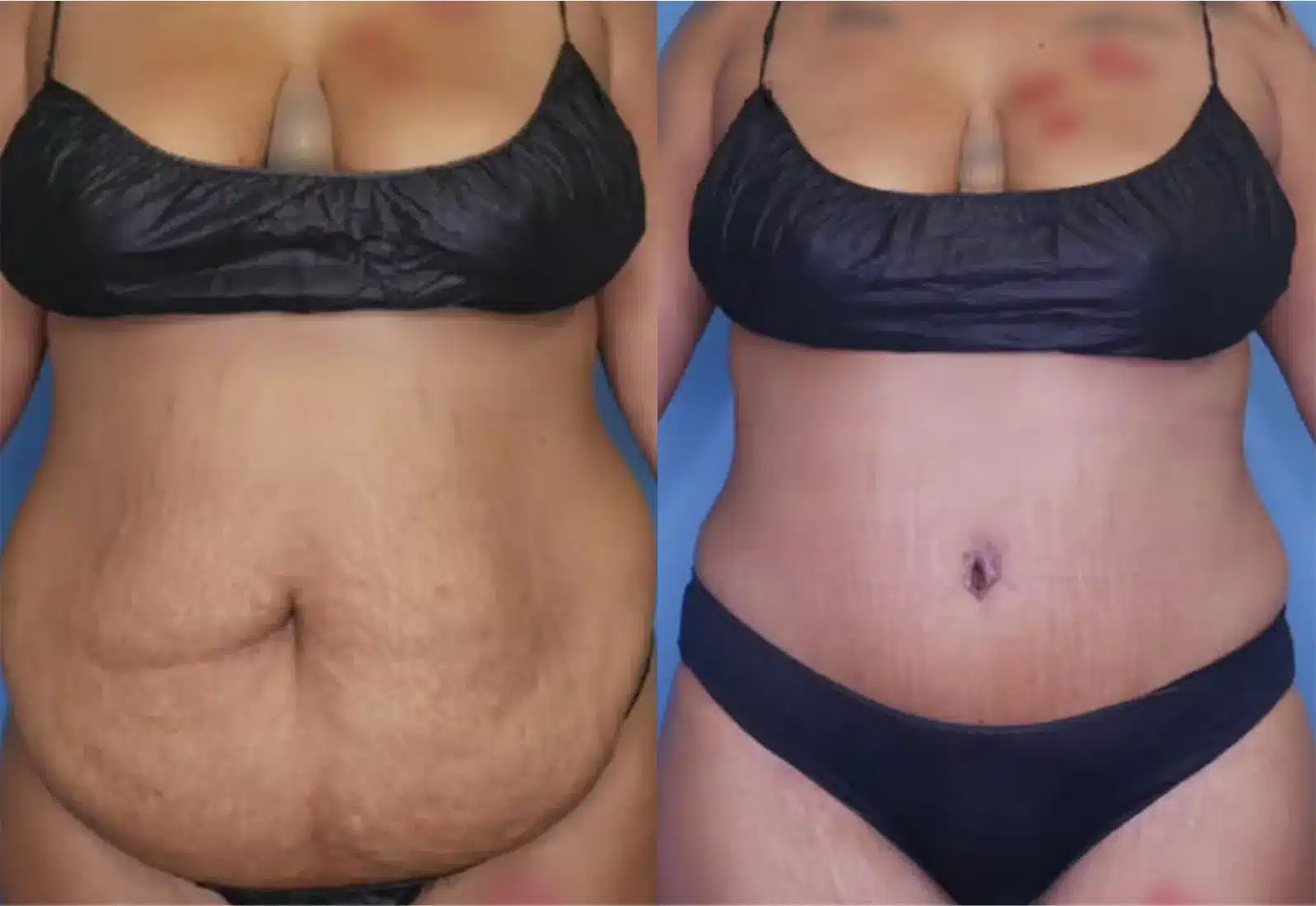 Before and After Image: Tummy Tuck (Abdominoplasty) - front