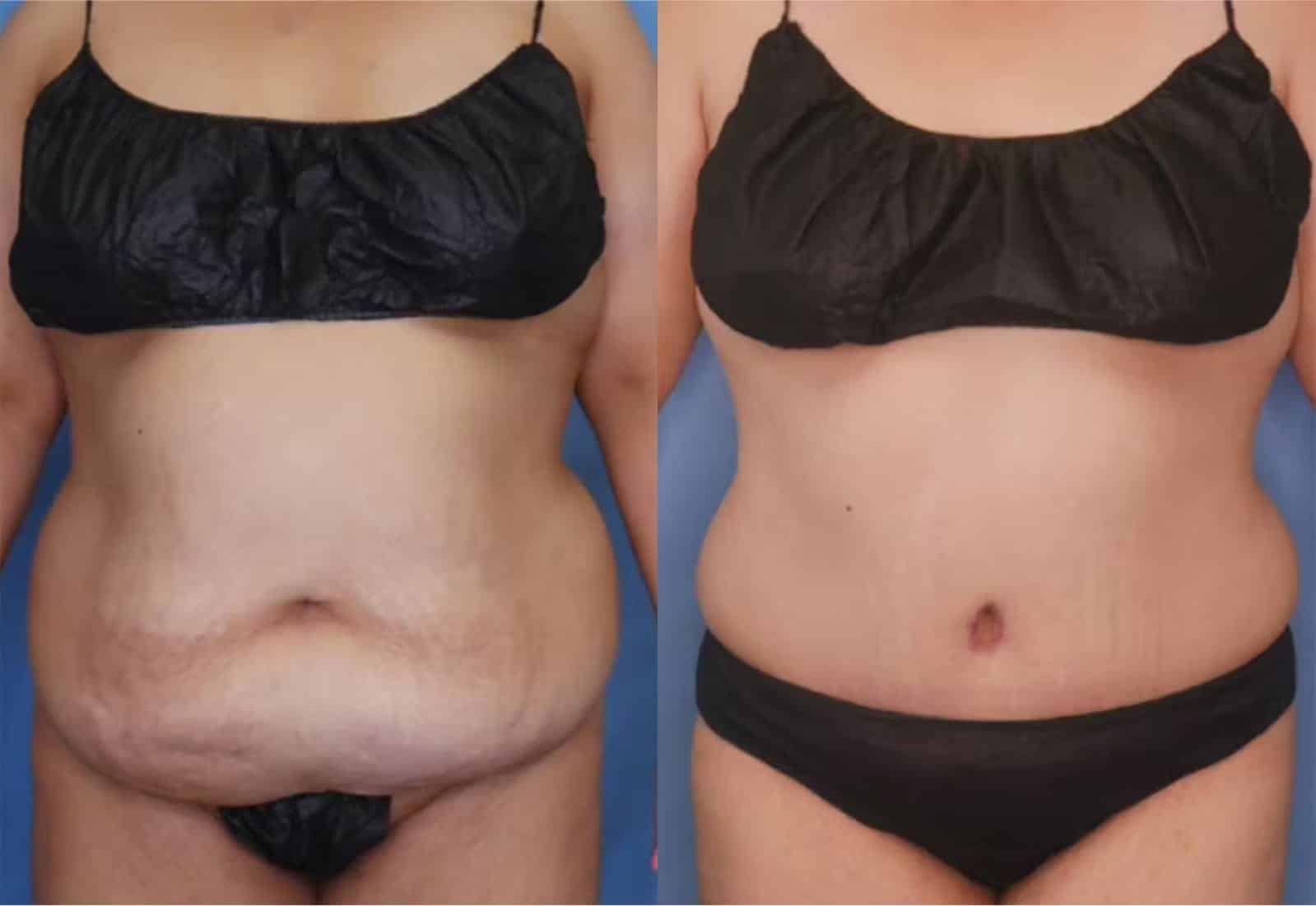 Before and After Image: Tummy Tuck (Abdominoplasty) - front