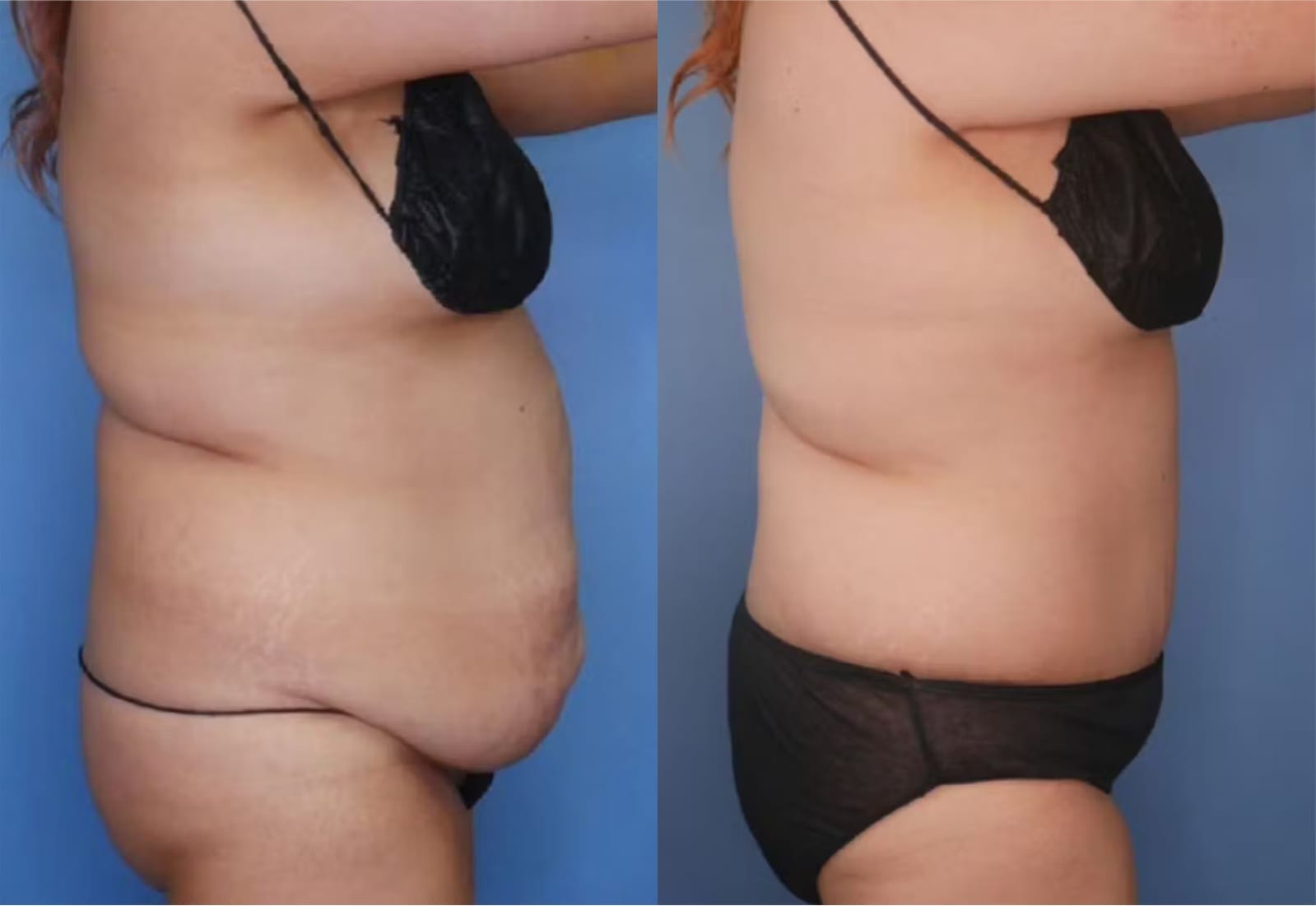Before and After Image: Tummy Tuck (Abdominoplasty) - right-side