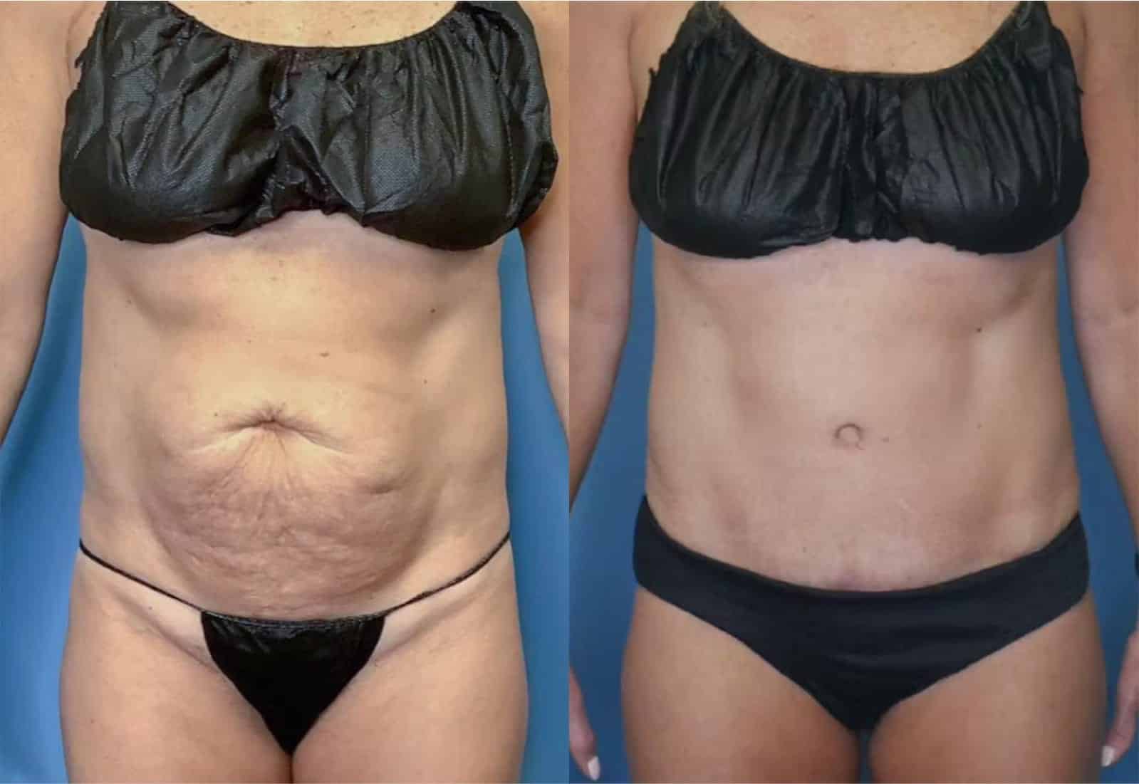 Before and After Image: Tummy Tuck (Abdominoplasty) - front
