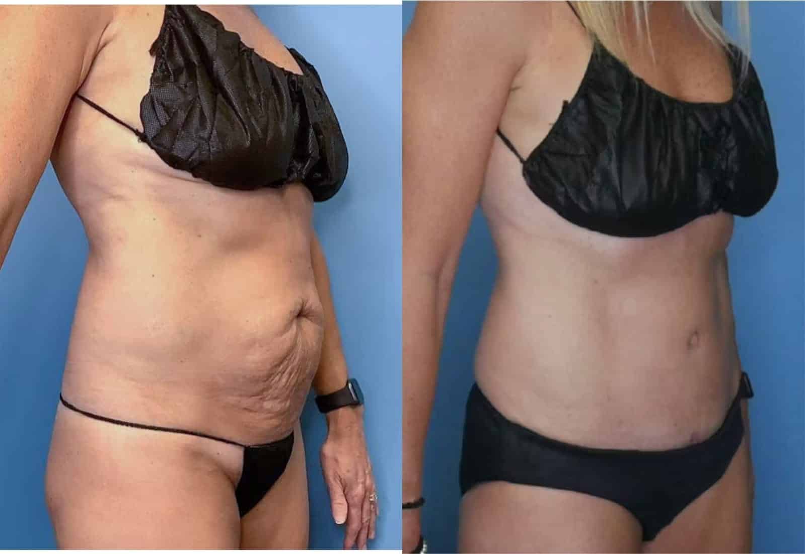 Before and After Image: Tummy Tuck (Abdominoplasty) - right-front-oblique