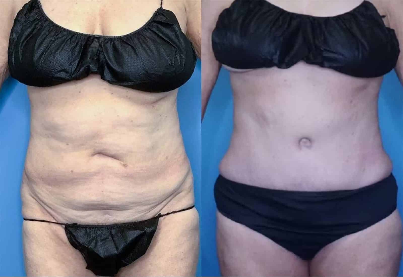 Before and After Image: Tummy Tuck (Abdominoplasty) - front
