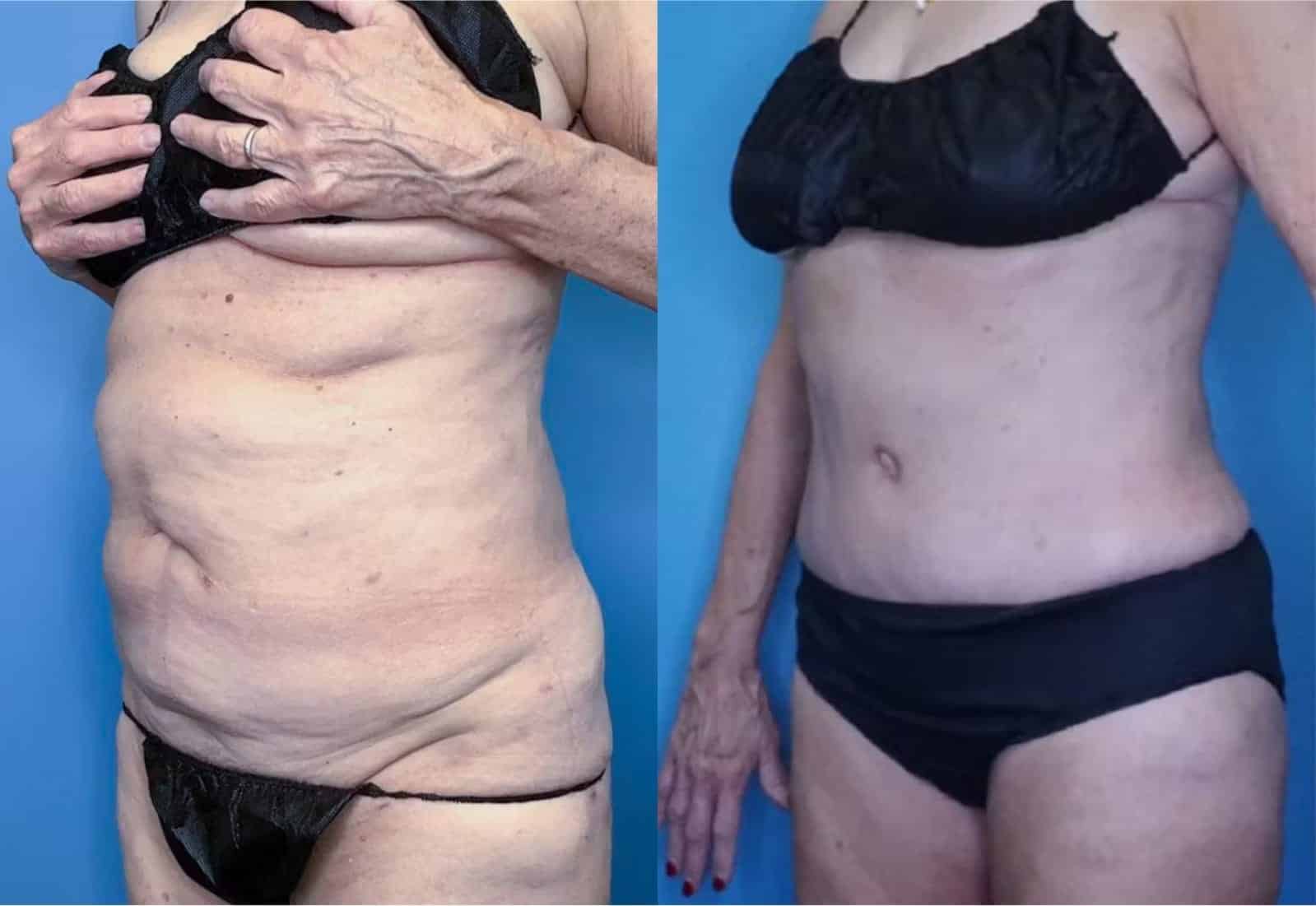 Before and After Image: Tummy Tuck (Abdominoplasty) - left-front-oblique