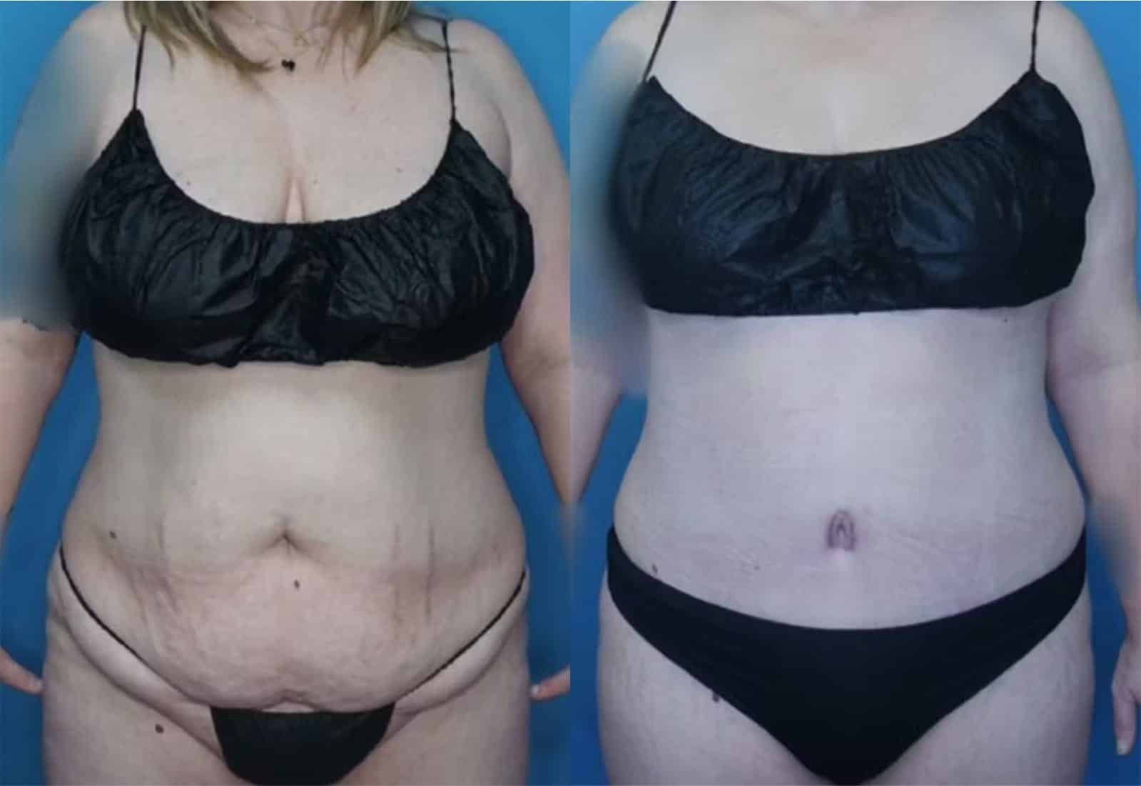 Before and After Image: Tummy Tuck (Abdominoplasty) - front
