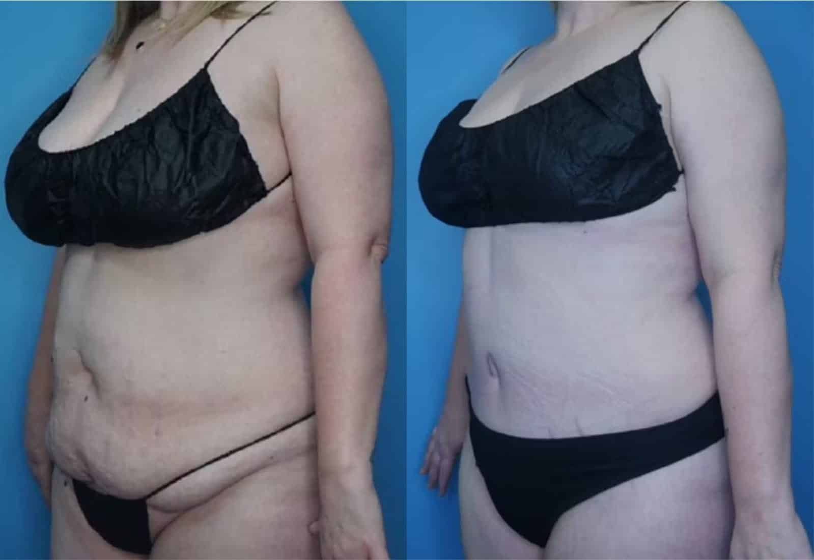 Before and After Image: Tummy Tuck (Abdominoplasty) - left-front-oblique