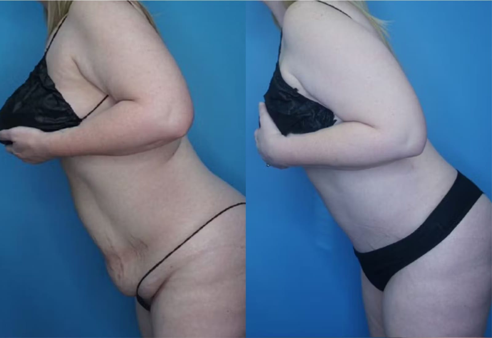 Before and After Image: Tummy Tuck (Abdominoplasty) - other