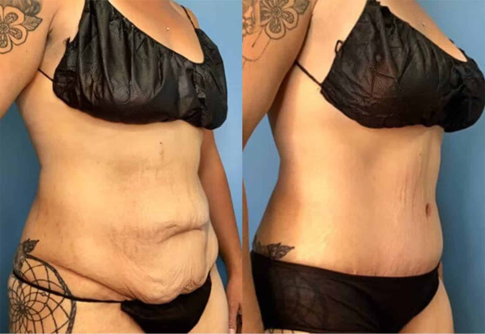 Before and After Image: Tummy Tuck (Abdominoplasty) - right-front-oblique