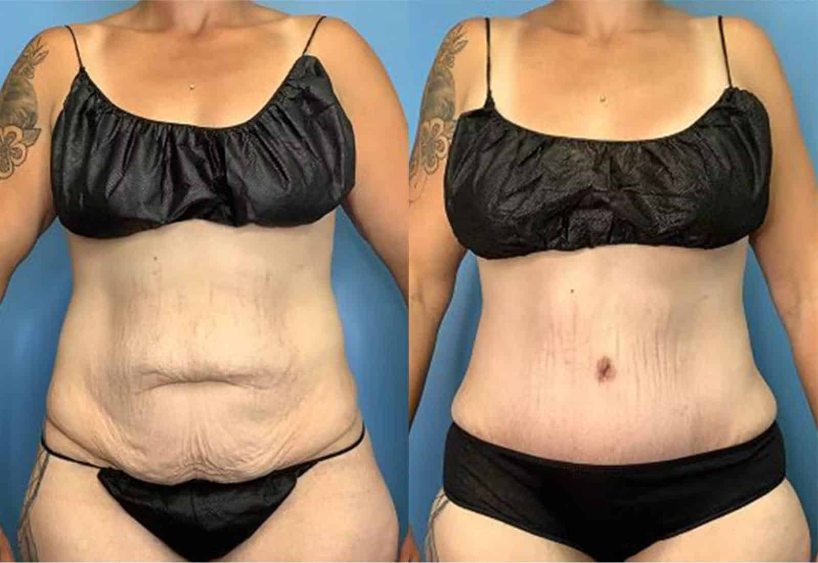 Before and After Image: Tummy Tuck (Abdominoplasty) - front