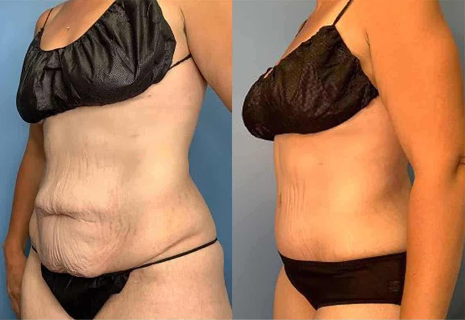 Before and After Image: Tummy Tuck (Abdominoplasty) - left-front-oblique