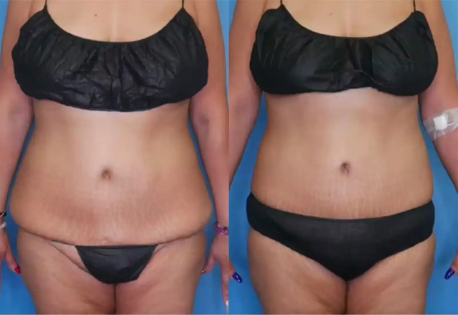 Before and After Image: Mini Tummy Tuck - front