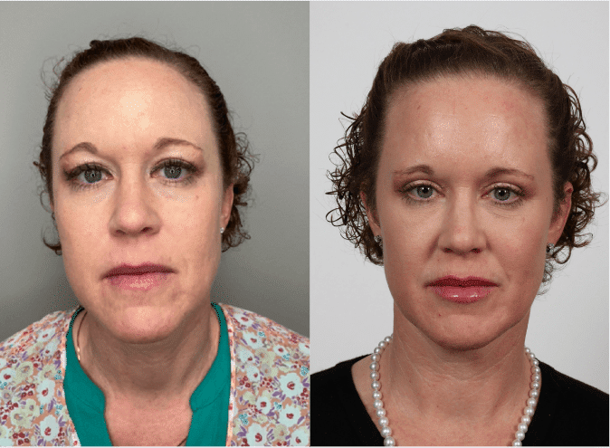 Before and After Image: Under Eye Filler - front