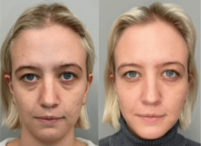 Before and After Image: Under Eye Filler - front