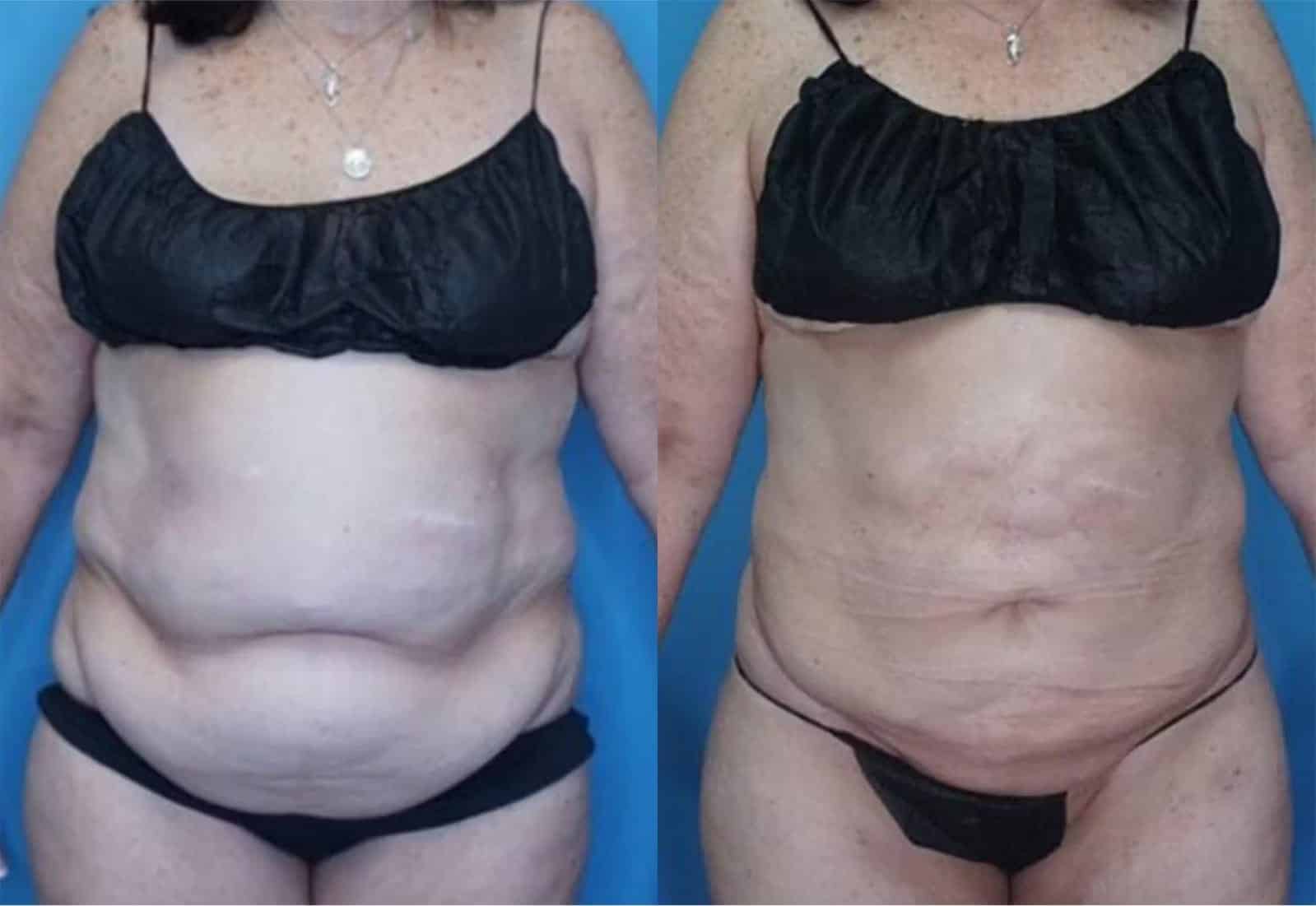 Before and After Image: Vaser Liposuction - front