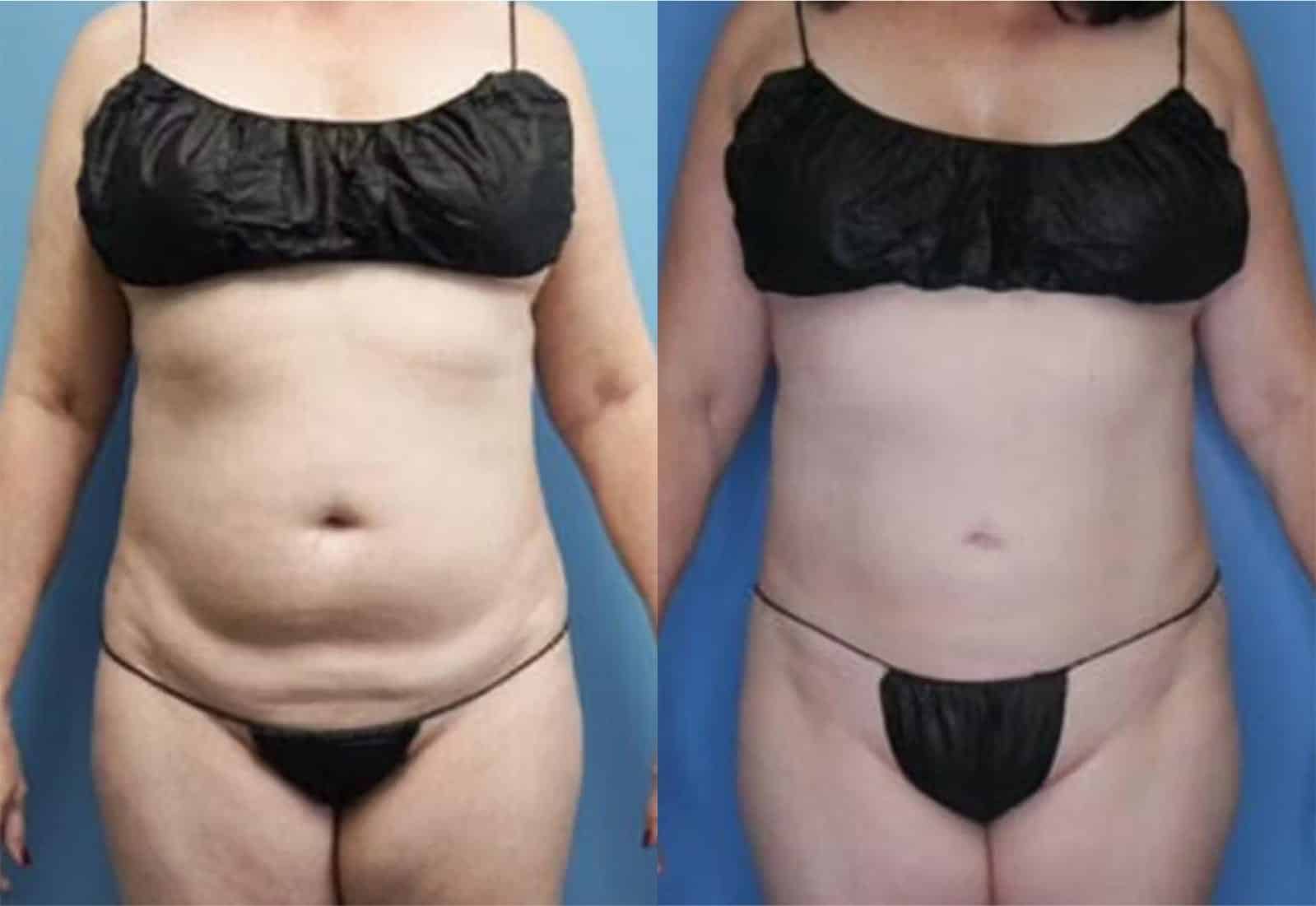 Before and After Image: Vaser Liposuction - front