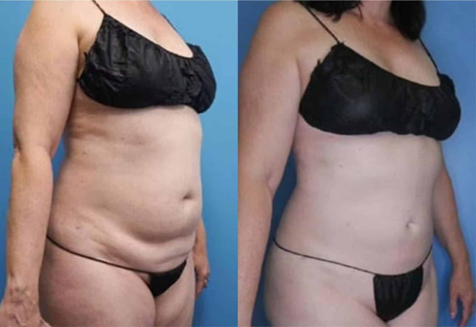 Before and After Image: Vaser Liposuction - right-front-oblique